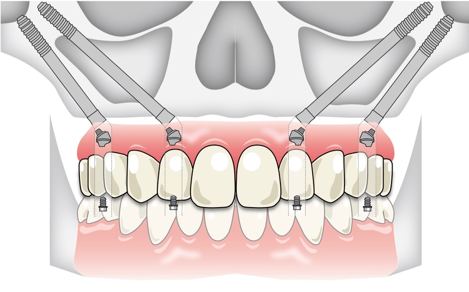 インプラント を 断られた なら Extra Maxillo Zygomatic All-on-4