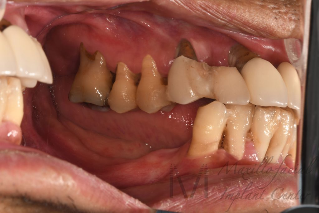 歯周病 で 歯がぐらつく ような口腔内の側面観