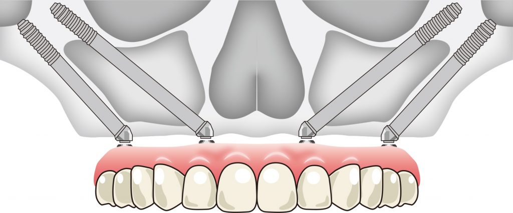 Extra Maxillo Zygomatic All-on-4　ザイゴマインプラント