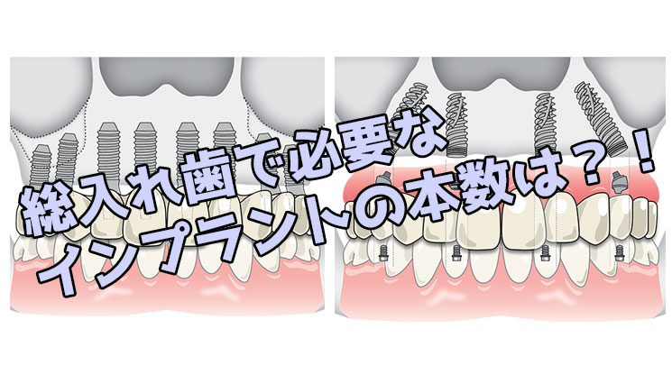 総入れ歯　インプラント　本数