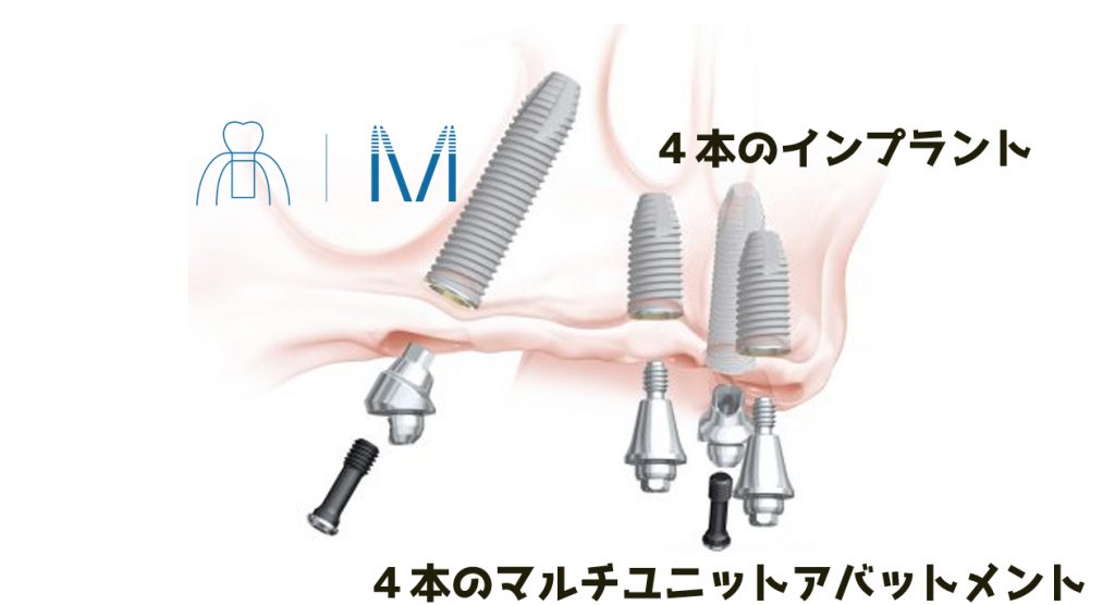 All-on-4 マルチユニットアバットメント 調整