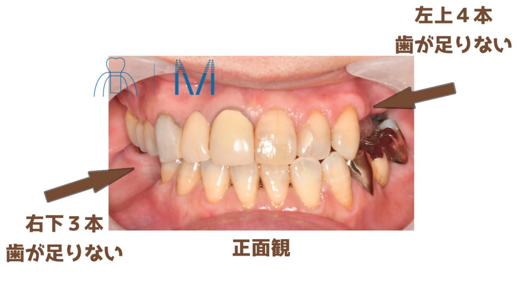 インプラントをしたいが骨がない