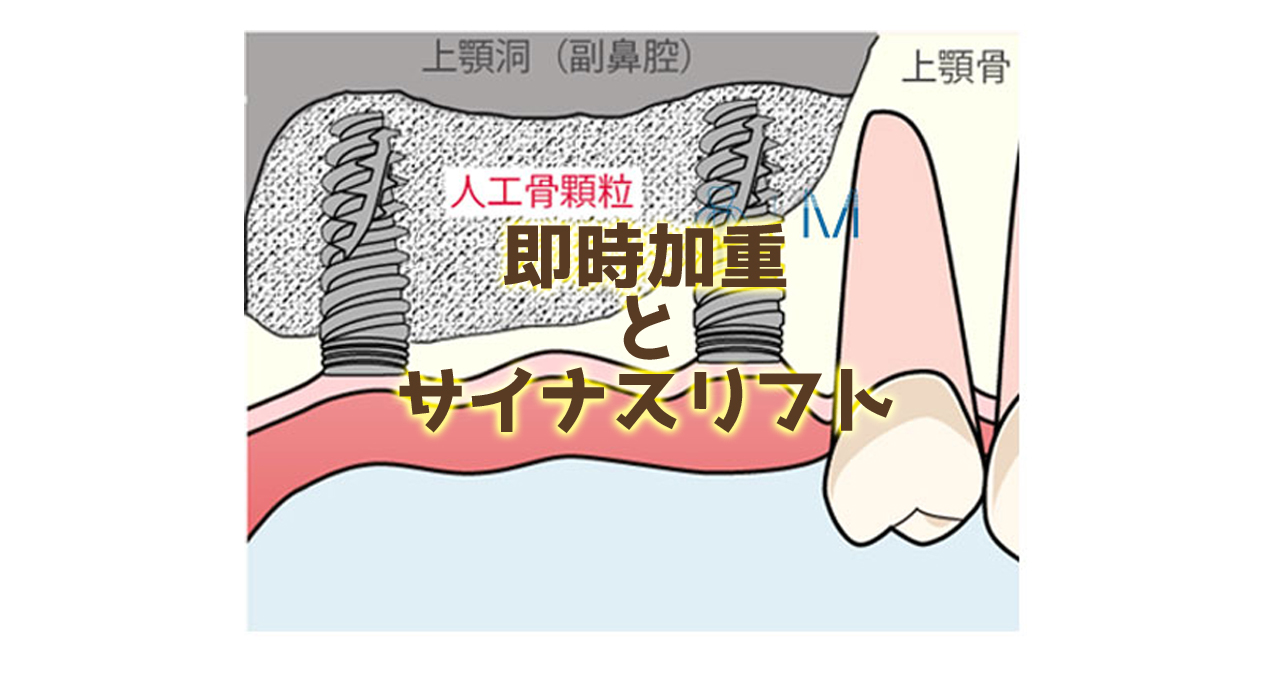 即時加重 と サイナスリフト