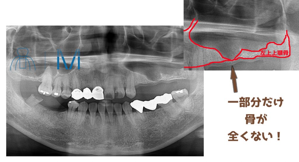 一部分だけ骨が全くない