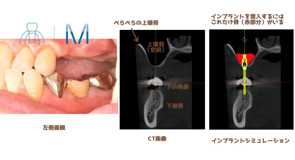 インプラントシミュレーション