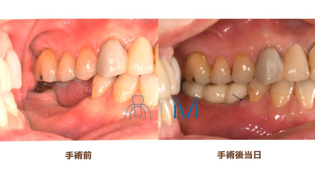 即時加重 before after