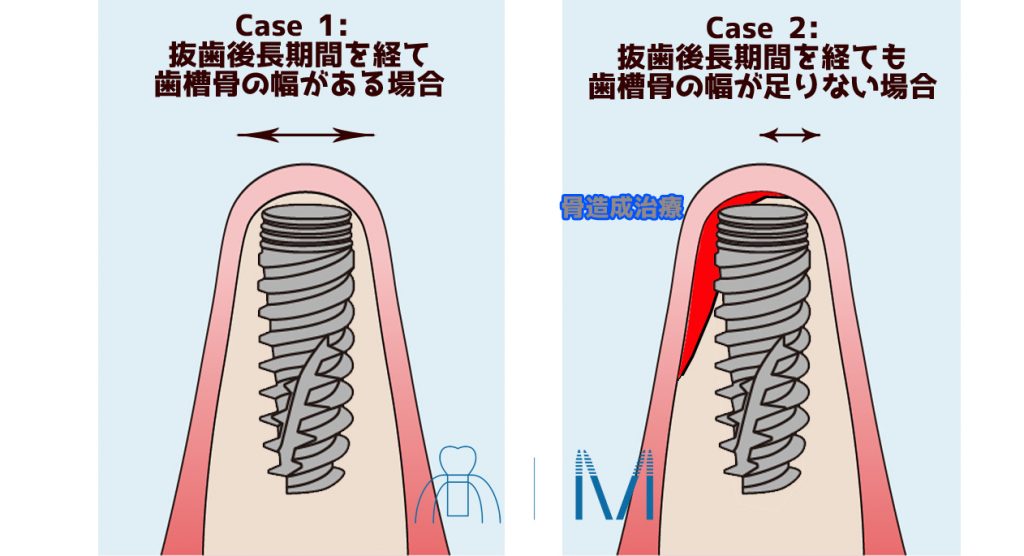 抜歯後待機埋入