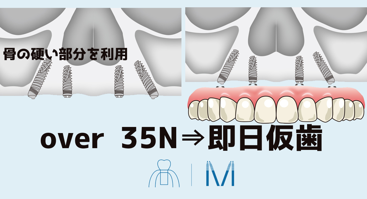 即時荷重インプラント