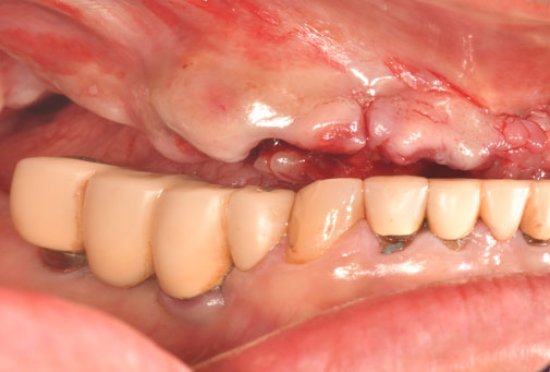 即時義歯の下