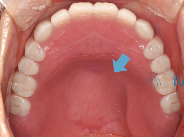 総義歯の口蓋部