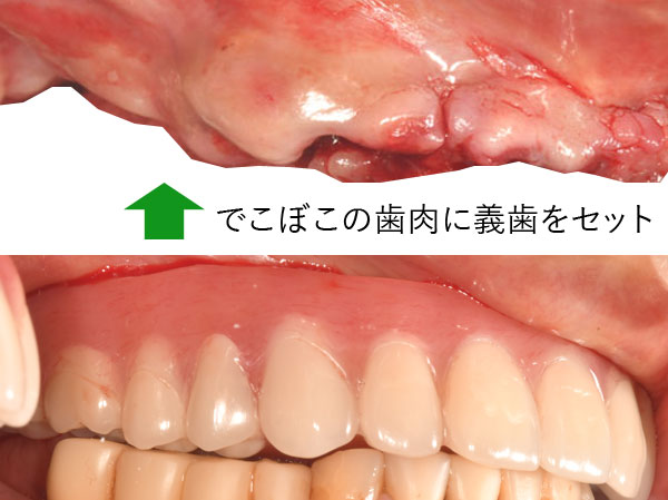 抜歯窩　歯肉と骨は変化する