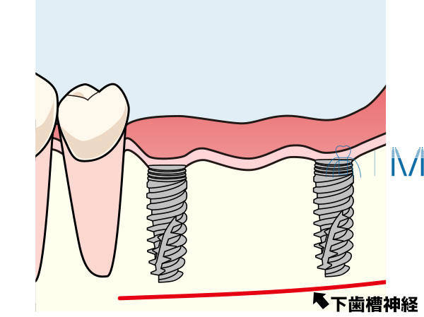 インプラントと下歯槽神経