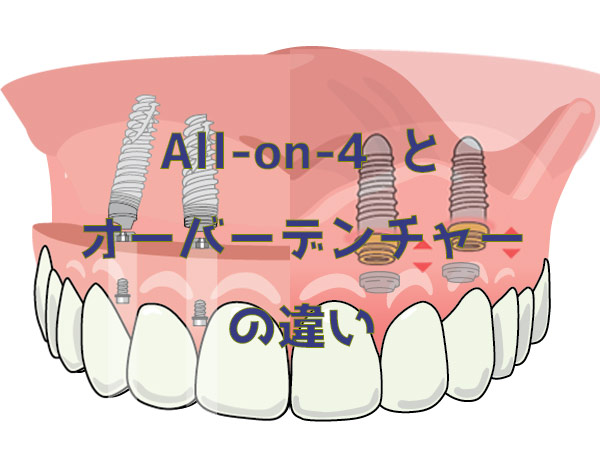 All-on-4 と オーバーデンチャー の違い