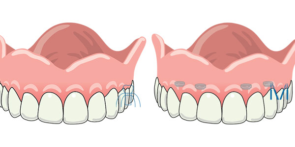 総義歯とオーバーデンチャー