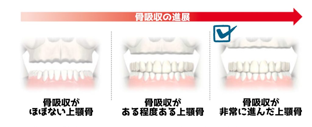 骨吸収が進んだ時のインプラント