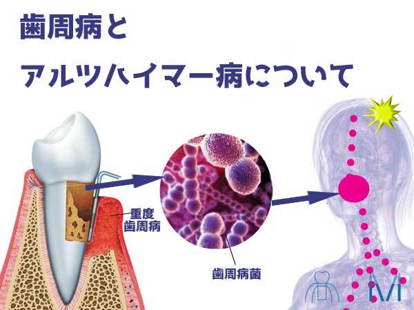 歯周病とアルツハイマー