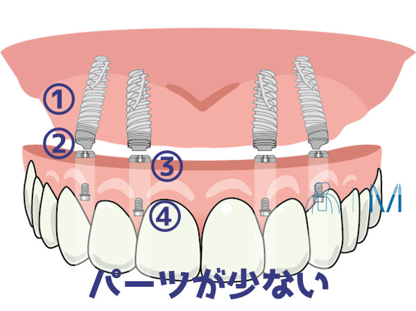 オールオン4 総費用を抑えられる