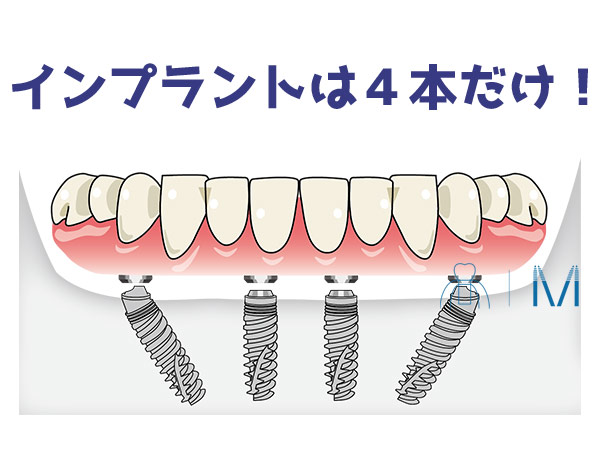 All-on-4 最小限の侵襲