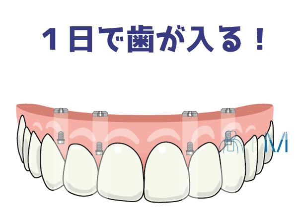 オールオンフォー　１日で歯が入る