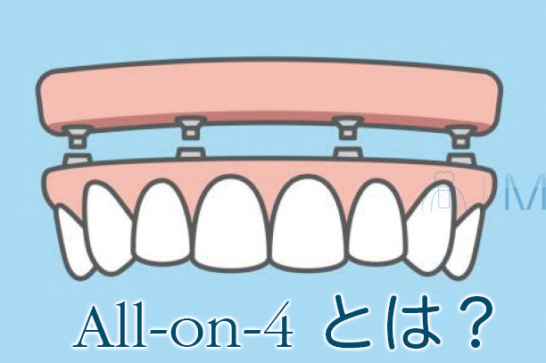 All-on-4とは　定義 オールオンフォー