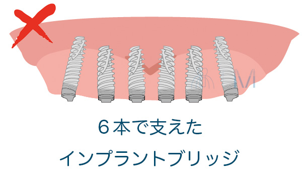 6本で支えたインプラントブリッジ