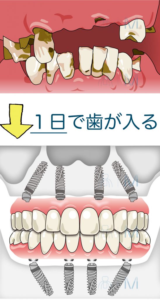 １日で歯が入る