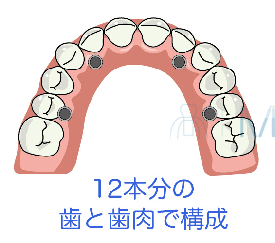 オールオンフォーは12本分の歯と歯肉から