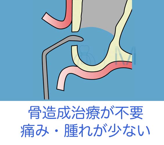 骨造成は痛い・腫れ