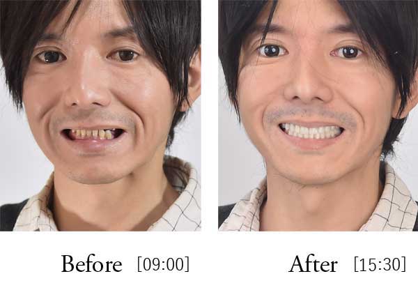 All-on-4 before after