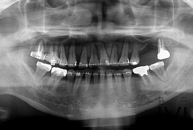 成人歯列矯正　前歯グラグラ