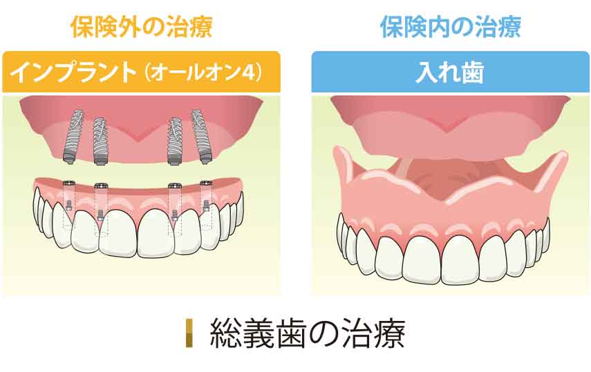 総義歯の治療（オールオン4 入れ歯）