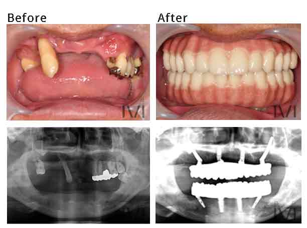 入れ歯　オールオン4