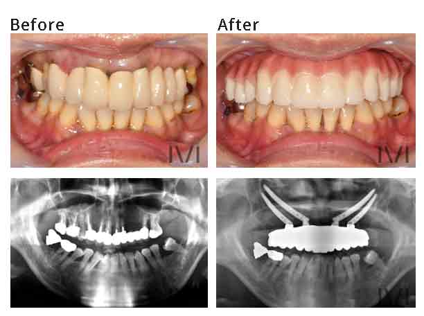 上顎　オールオン4　治療