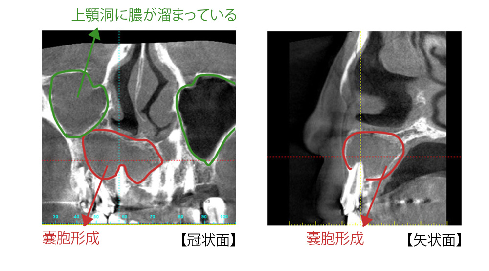 歯根嚢胞