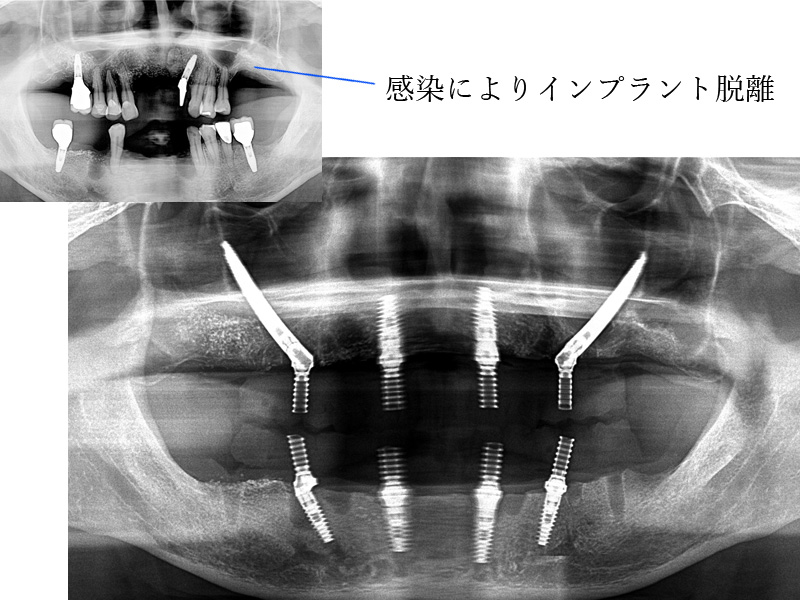 ザイゴマインプラント　他院のリカバリー