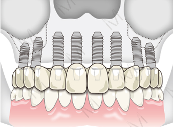 総インプラント