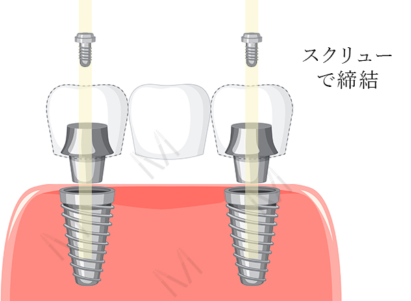 固定式の欠損補綴治療