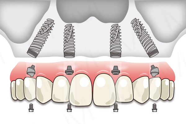 オールオン4 のメリット