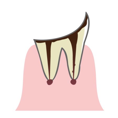 虫歯　残せない歯